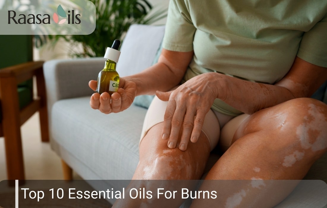 Top 10 Essential Oils For Burns