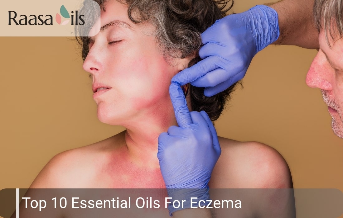 Top 10 Essential Oils For Eczema